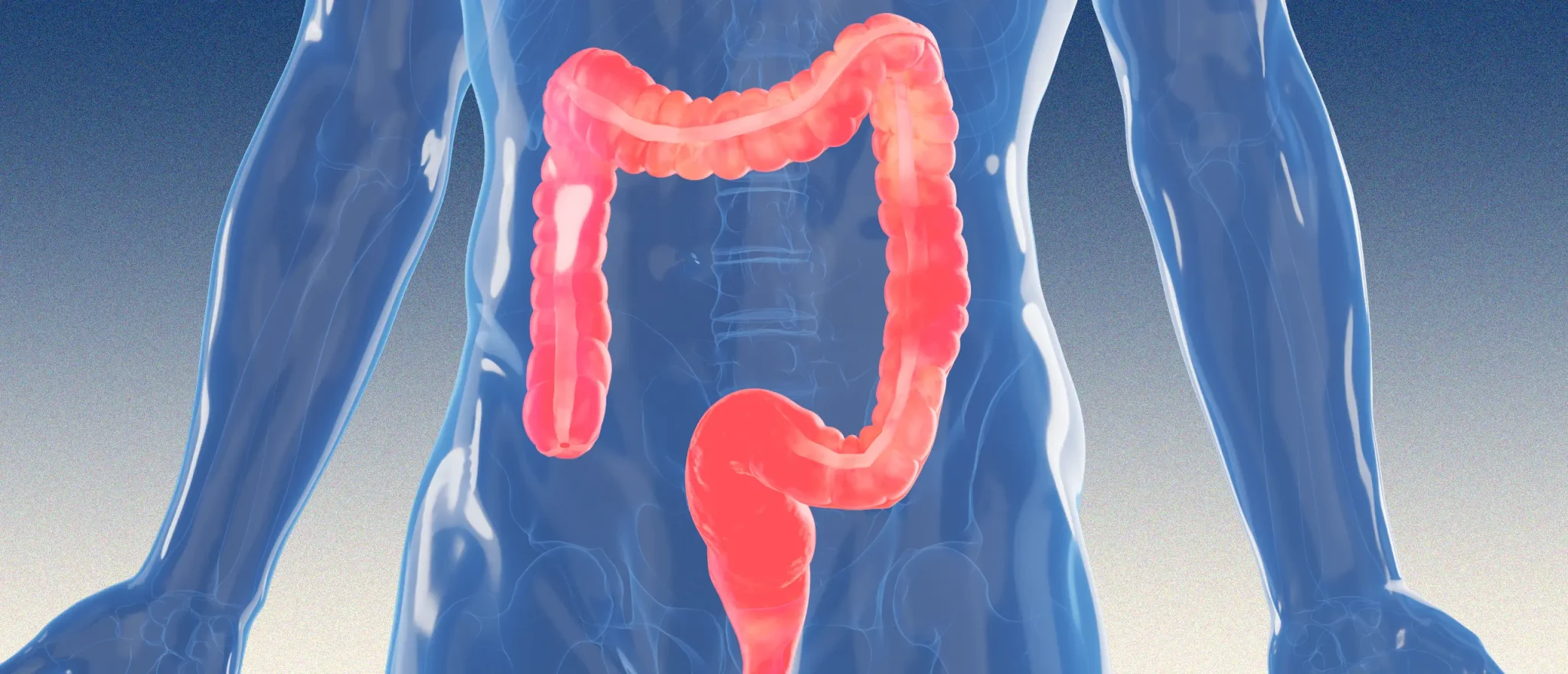 Why Are So Many Young People Getting Colorectal Cancer?