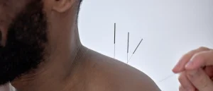 Man getting acupuncture on shoulder